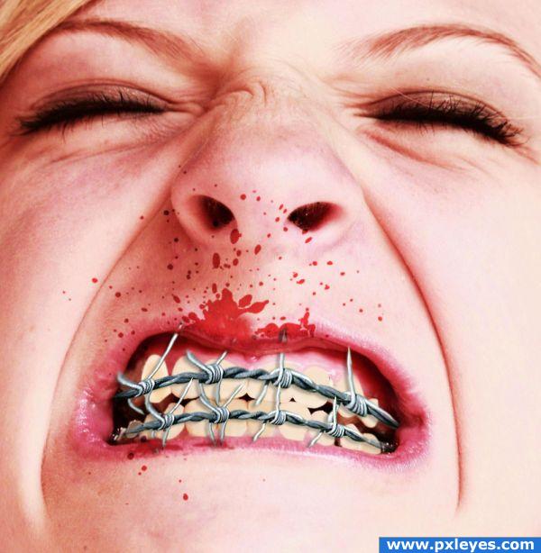 Braces